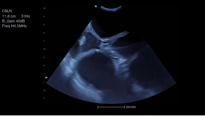 Ultrasound scan showing pyometra